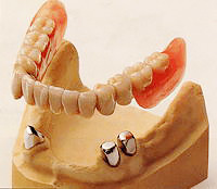 「茶筒の原理」を利用したコーヌスクローネ義歯