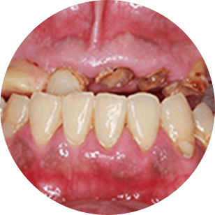 ボロボロの歯